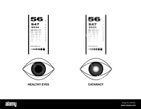 Cataract Eye Test Chart