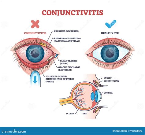 conjunctivitis diagram 