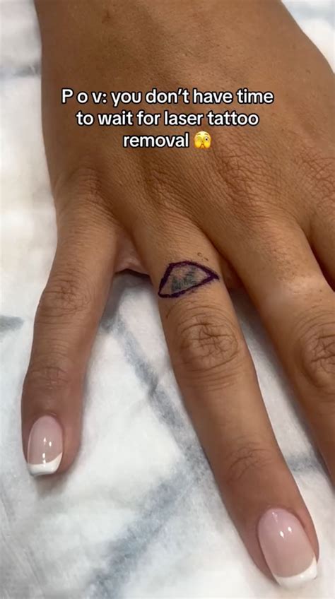cut off finger tattoo, Finger tattoo removal services
