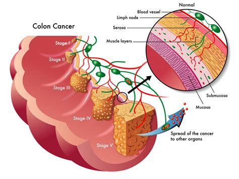 diagram for colon cancer colon 