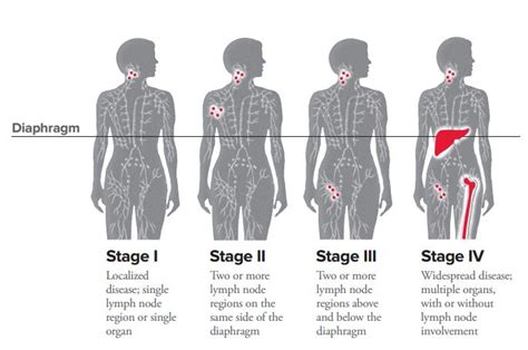 diagram for lymphoma staging 