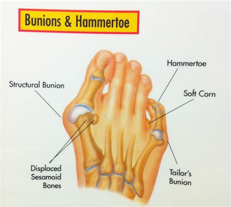 diagram of bunion 