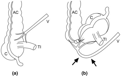 diagram of cecal volvulus 