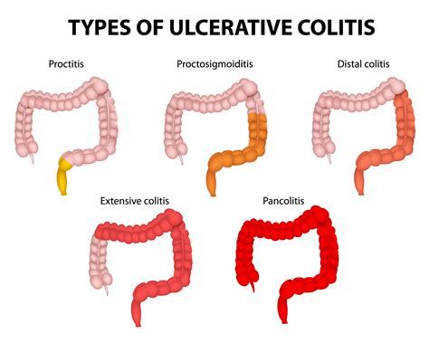 diagram of colitis 