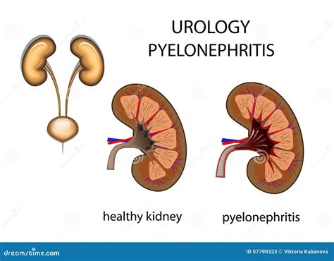 diagram of pyelonephritis 