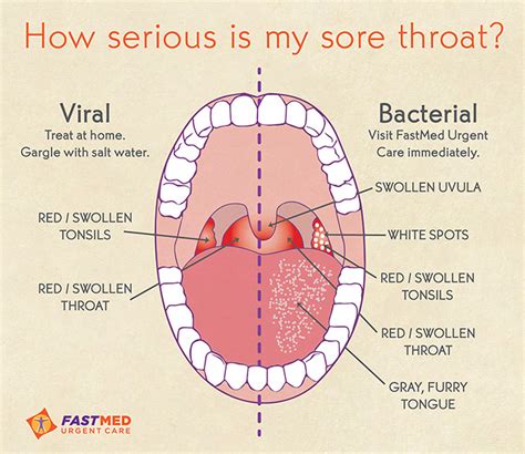 diagram of sore throat 