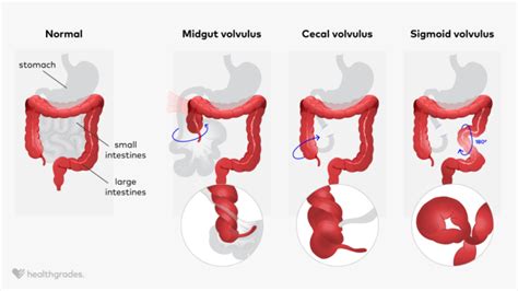 diagram of volvulus 