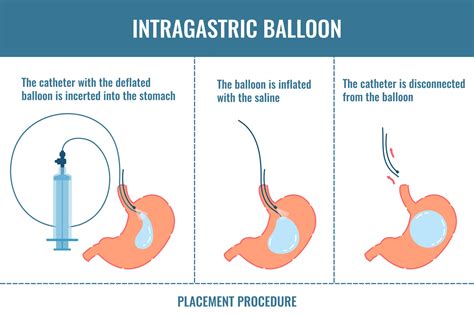 gastric balloon landstinget