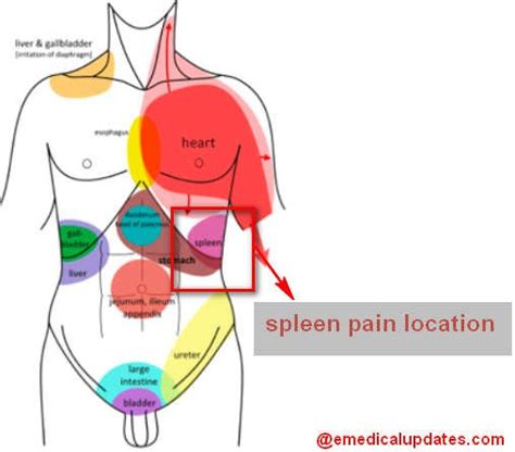 gastritis pain location diagram 