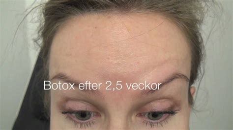 hängande ögonlock efter botox