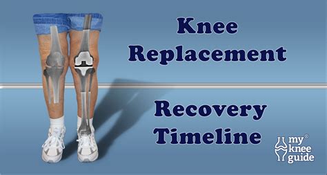 how many days should i ice after knee replacement surgery