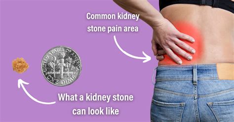 Kidney Stone Pain Chart