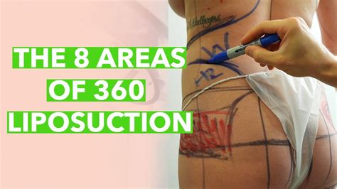 liposuction areas diagram 