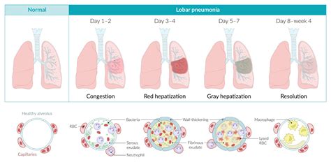 lobar pneumonia diagram 