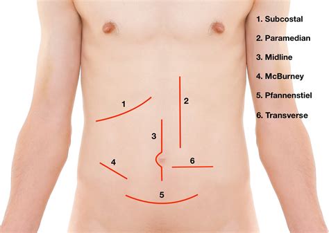 lower abdominal incision diagram 