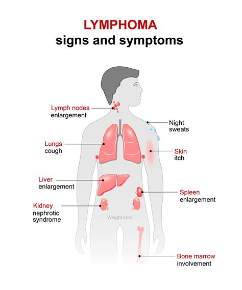 lymphoma cancer diagrams 