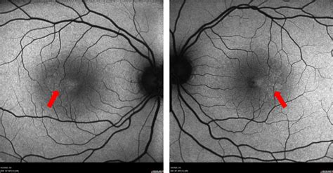 mac tel blue image, Functional relevance of macular telangiectasia (mactel) area on