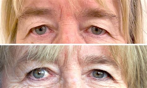 när försvinner hängande ögonlock efter botox