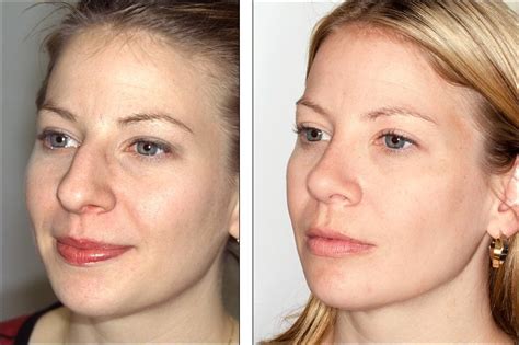 näsoperation före och efter
