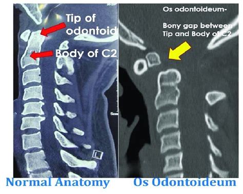 os odontoideum, Os odontoideum