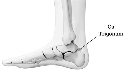 os trigonum, Trigonum os ankle foot. Os trigonum/os trigonum syndrome