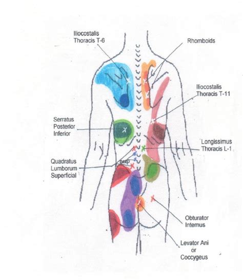 pinpoint lumbar back pain diagram 