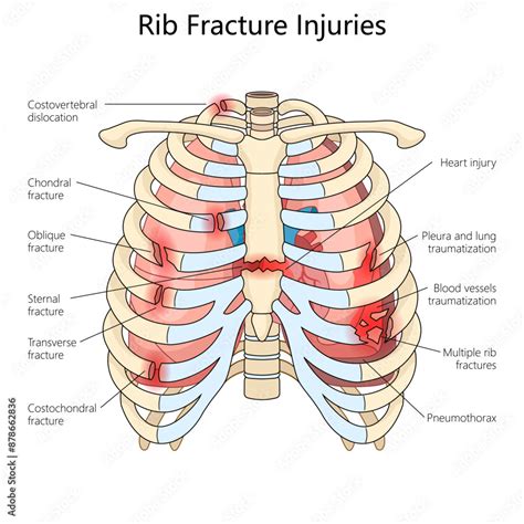rib  damage diagram 