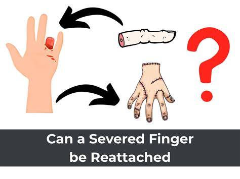 severed finger