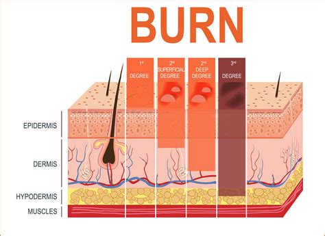 skin burn diagram 