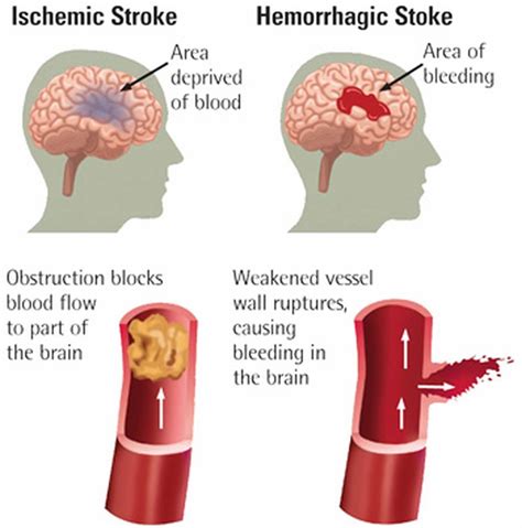 stroke schematic diagram 