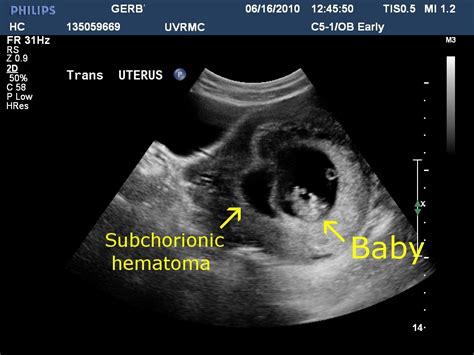 Subchorionic Hematoma Size Chart