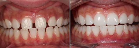 tandfasader före och efter