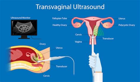 transvaginal ultrasound diagram 