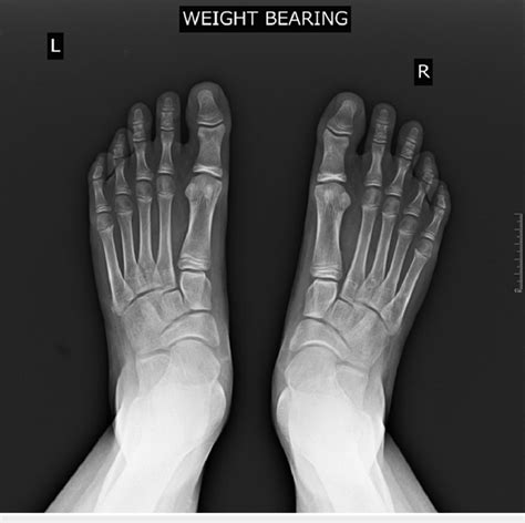 weight bearing x ray foot