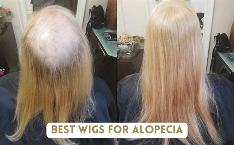 wigs for alopecia